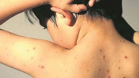 126% increase in hospitalisations from chickenpox