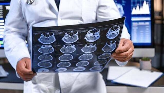 Brain tumour diagnoses among Irish adults up 35% in 30 years