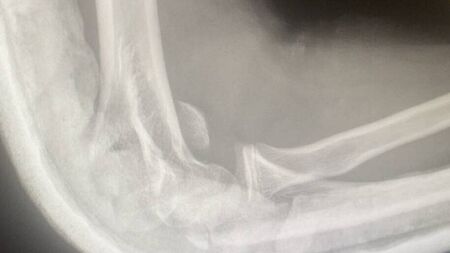 Teen suffers broken arm in horrific filmed beating