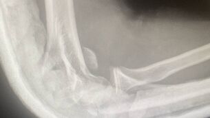 <p>The X-Ray of the teen's fractured arm</p> <p>The X-Ray of the teen's fractured arm</p>