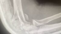 Teen suffers broken arm in horrific filmed beating