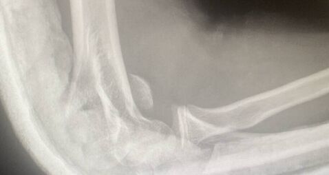 Teen suffers broken arm in horrific filmed beating